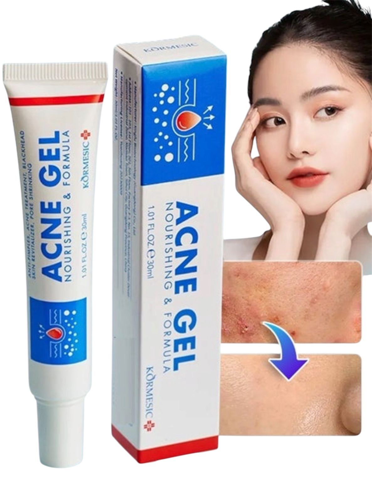 Acne gel